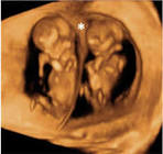 Paña/Gemelos Med/12